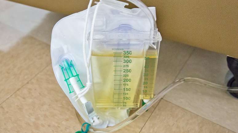 Pacientes com hiperplasia de pr&oacute;stata, como o presidente Michel Temer, muitas vezes precisam recorrer a sondas urin&aacute;rias