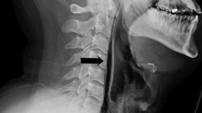 A flecha indica a fratura da garganta | Foto: BMJ