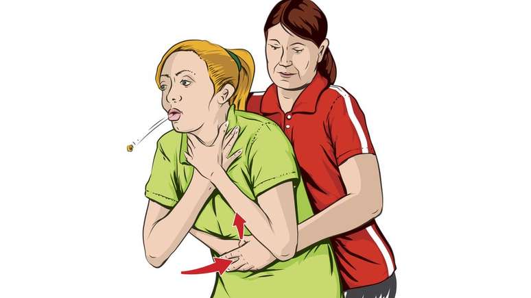 A 'manobra de Heimlich' &eacute; quando uma pessoa pressiona sua barriga para formar uma corrente de ar ao contr&aacute;rio que vai expulsar o objeto que obstrui o caminho do oxig&ecirc;nio para o pulm&atilde;o