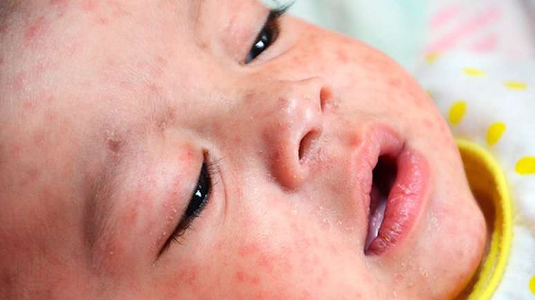Crianças pequenas não vacinadas são o grupo que corre mais risco | foto: SPL