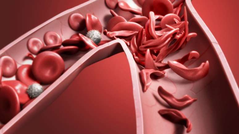 Glóbulos vermelhos mal formados causam diversos problemas de saúde | Foto: Science Photo Library
