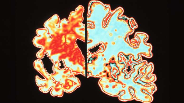 Alzheimer's disease brain (left) compared to normal (right)