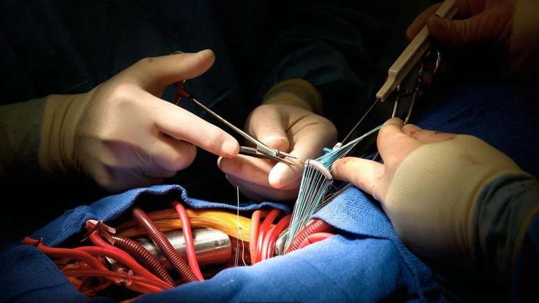 Curativo impresso em 3D seria costurado diretamente no cora&ccedil;&atilde;o