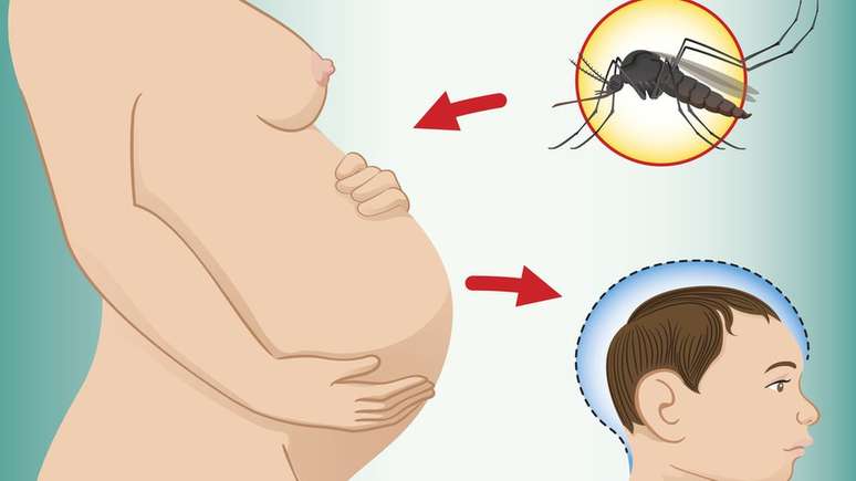 O avan&ccedil;o da microcefalia ligada ao zika v&iacute;rus nas Am&eacute;ricas foi considerado uma emerg&ecirc;ncia internacional pela OMS em 2016