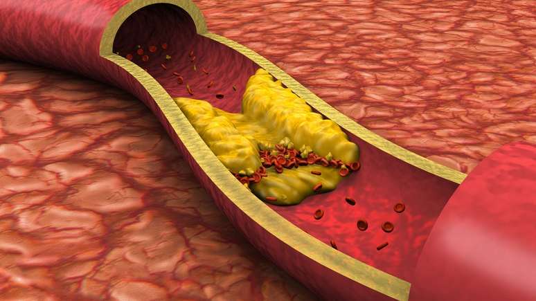 Com aumento da pressão arterial, placas de gordura podem ser destruídas e bloquear artérias, causando até morte súbita