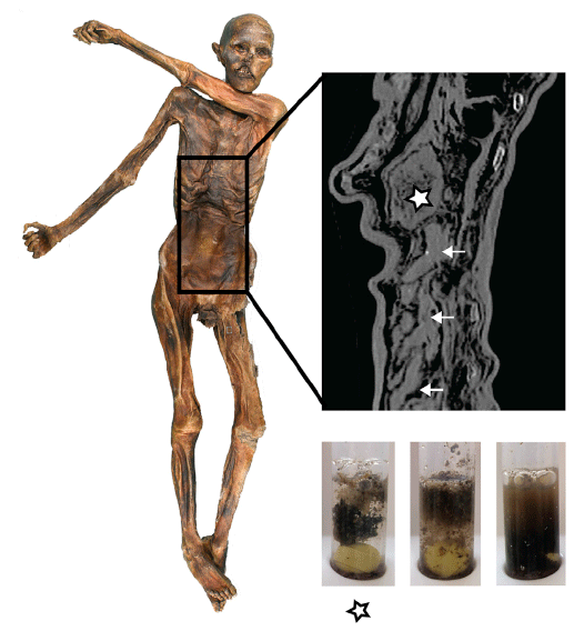 Imagem do trato digestivo do Homem de Gelo - estômago só foi localizado em exames 18 anos após a descoberta da múmia