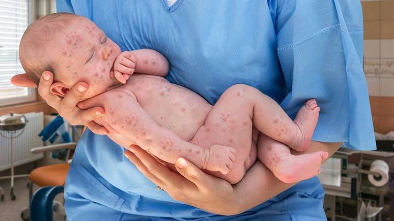 A partir dos 6 meses, os bebês podem tomar a primeira dose da vacina contra o sarampo