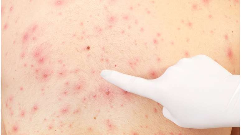 Febre, conjuntivite, manchas vermelhas na pele, tosse e coriza são alguns dos sintomas do sarampo