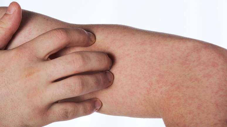 Vacina contra o sarampo j&aacute; foi administrada antes dos 12 meses de idade no Brasil, em esfor&ccedil;o para erradicar a doen&ccedil;a