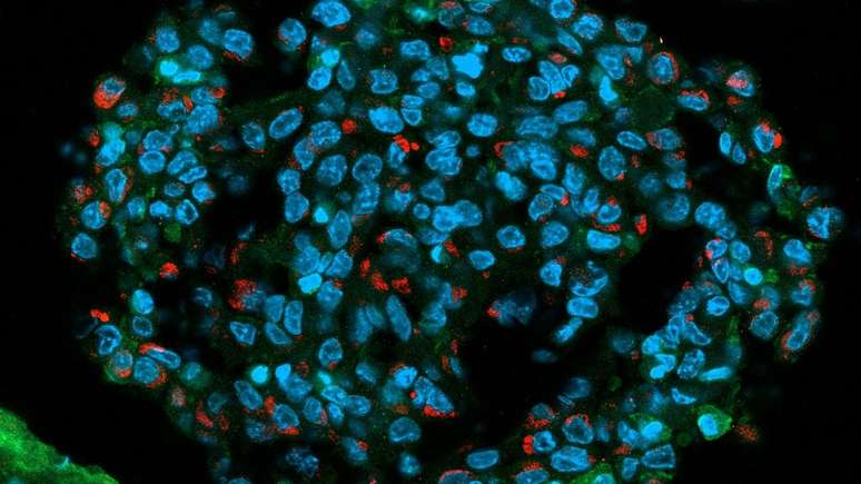 Pontos vermelhos indicam vírus zika agindo em núcleos de células tumorais (pontos azuis) em cérebro de camundongo | Crédito: CEGH-CEL
