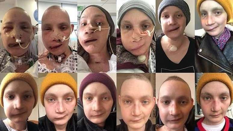 Jen Taylor, de 30 anos, diz que tirar uma foto todos os dias do próprio rosto ajudou a enfrentar as mudanças depois da cirurgia de reconstrução facial