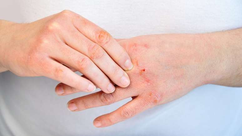 Muitos ingredientes em cosm&eacute;ticos podem ser alerg&ecirc;nicos