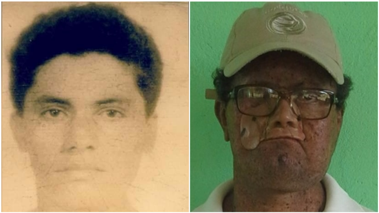 De&iacute;de aos 18 anos e agora; por causa da doen&ccedil;a xeroderma pigmentosum, ele perdeu parte do rosto