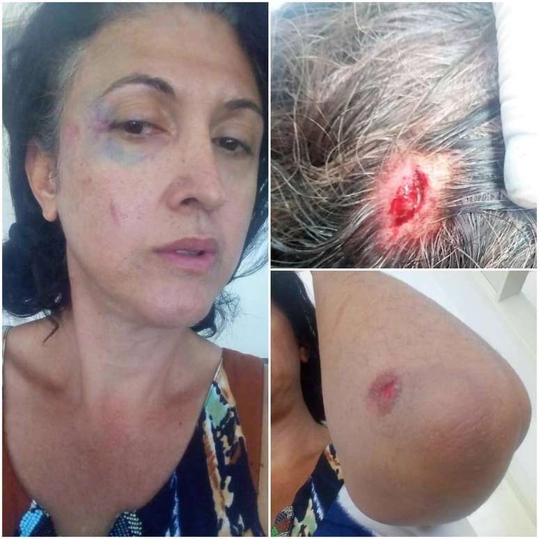 Fotos divulgadas pela trans Angela Lopes mostram os ferimentos