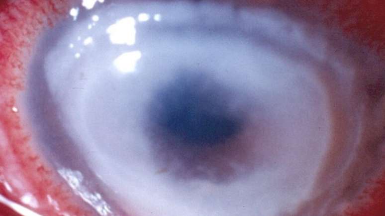 Imagem do olho de um paciente que ficou completamente cego após contrair a doença