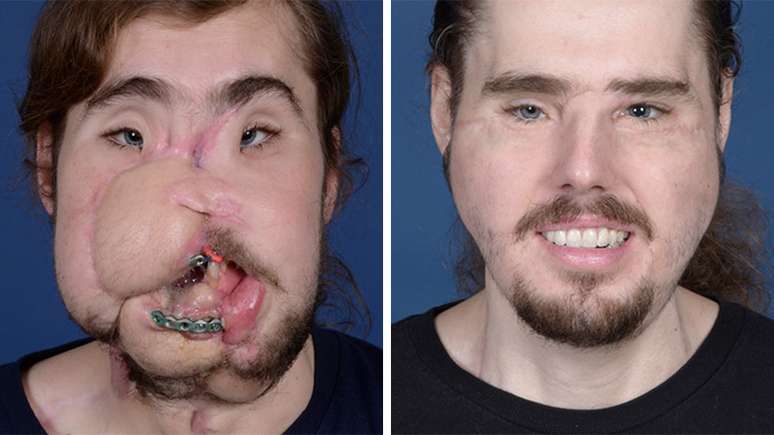 Cameron foi salvo com enxertos após a tentativa de suicídio (esq.) e conseguiu retomar sua vida após o transplante de rosto (dir.)