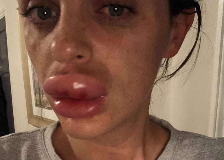 Rachael Knappier não saiu de casa por uma semana depois que seus lábios incharam muito por causa de um erro na aplicação de preenchimento labial.