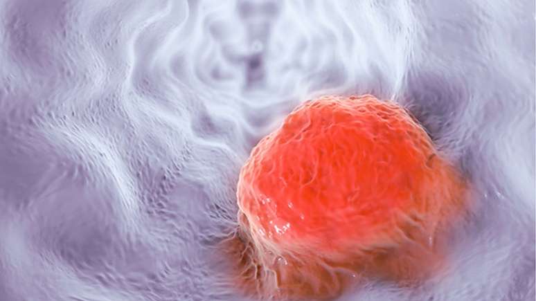 A ideia é descobrir se o câncer de esôfago (ilustração), por exemplo, deixa uma assinatura química na respiração