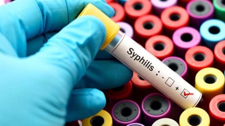 O teste para diagnóstico da sífilis é simples e rápido, feito por meio de exame de sangue e/ou esfregaço de lesão cutâneo-mucosa.