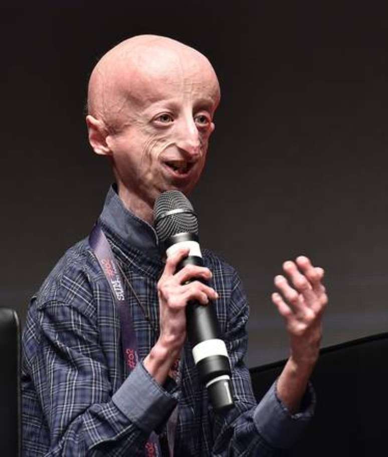 Itália opera coração de paciente com progeria pela 1ª vez