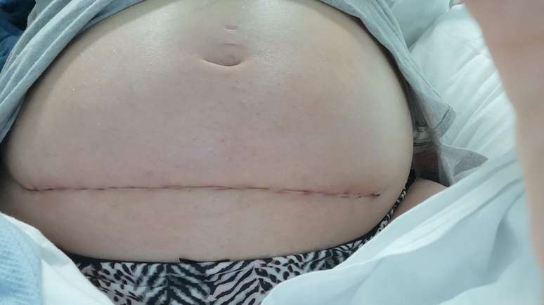 Bethan Simpson foi operada na 24ª semana de gestação para reparar a espinha bífida de sua filha