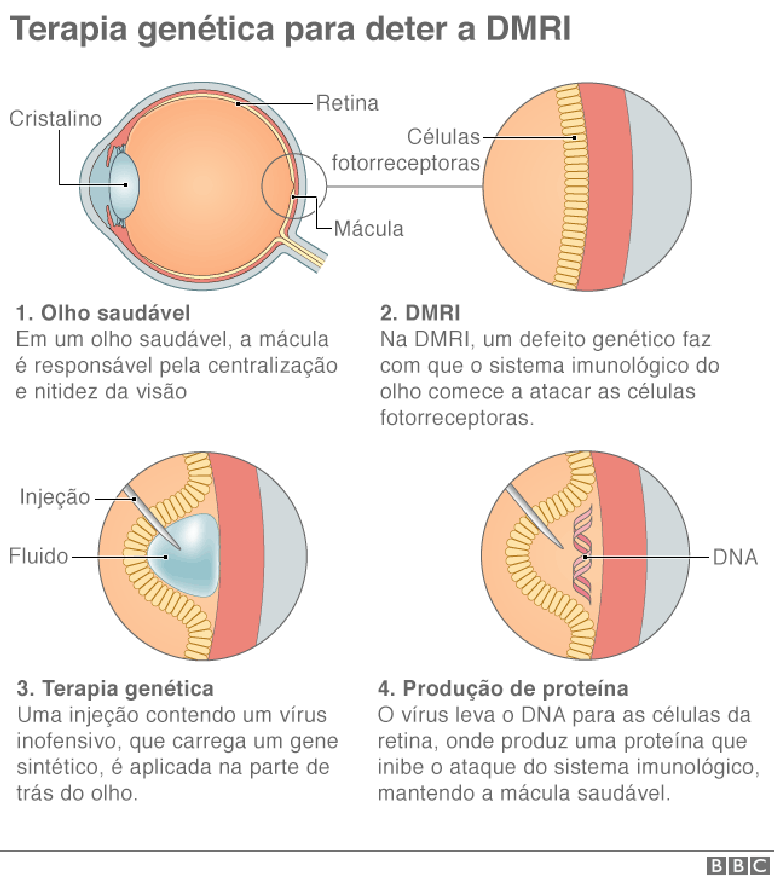 Terapia genética para deter a DMRI