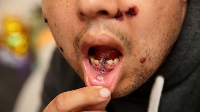 James Myers mostra a cicatriz deixada pelo projétil que atingiu sua boca