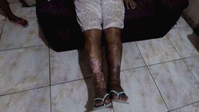 Comerciante de 53 anos diz que convivência com alagamentos causou infecção nas pernas