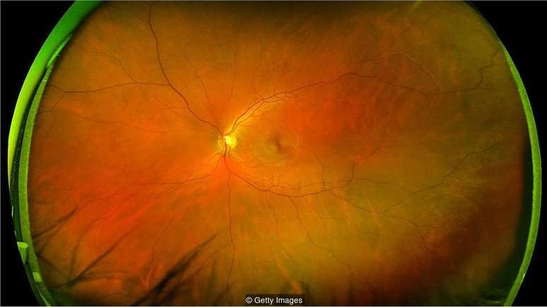 Os padrões de vasos sangüíneos na retina na parte posterior do olho revelam se você está correndo risco de sofrer um ataque cardíaco