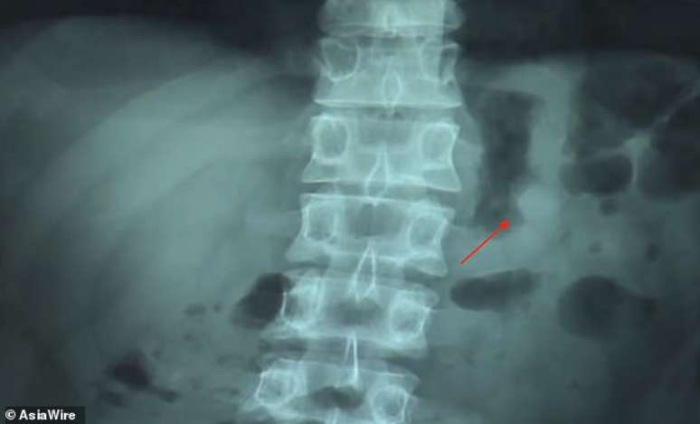 Imagem mostra o que parece ser a cabeça do fone dentro de Ben Hsu (fonte: AsiaWire/Daily Mail)