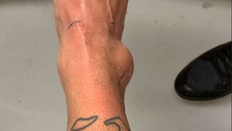 Neymar divulga inchaço do tornozelo direito
