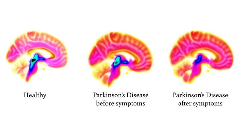 Tomografias do crânio mostram uma redução na serotonina (área azul/preta) à medida que o Parkinson avança ('Saudável', 'Parkinson antes dos sintomas' e 'Doença de Parkinson')