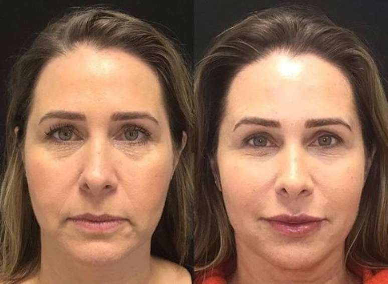 A ex-paquita Andrea Sorvetão, que realizou procedimento de harmonização facial.