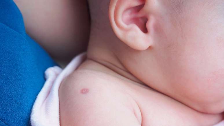 A BCG previne a tuberculose e é, junto com a imunização para hepatite B, aplicada ainda quando o bebê é recém-nascido