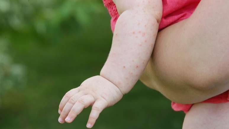 O sarampo pode gerar complicações graves especialmente em crianças