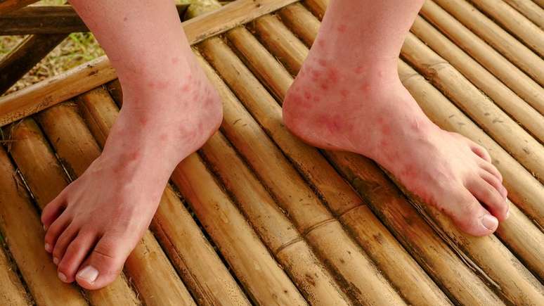 Manchas avermelhadas na pele são um dos sintomas mais comuns do sarampo