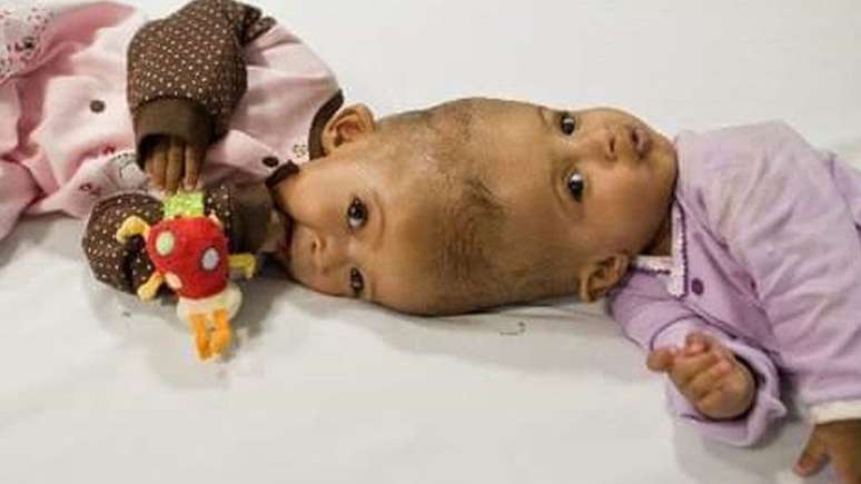 Rital e Ritaj Gaboura, gêmeas do Sudão, tinham 11 meses de idade quando foram operadas