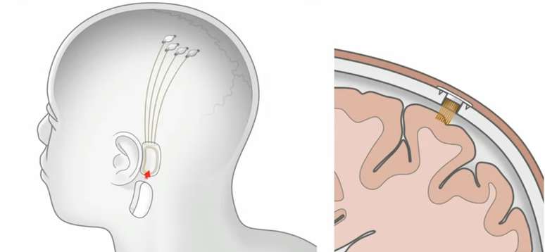 (Fonte: Neuralink/Reprodução)