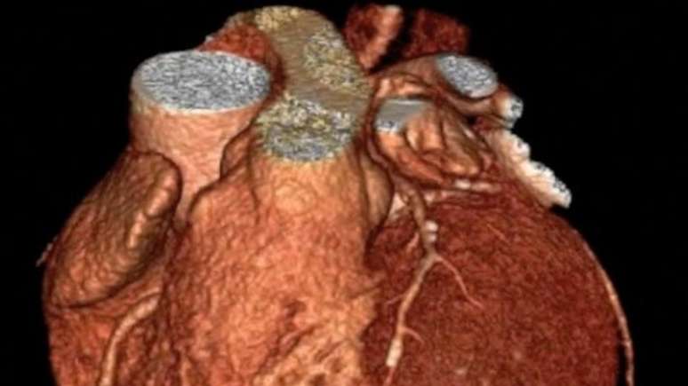 Cientistas identificaram gene que deixa os seres humanos predispostos a ter problemas cardíacos. A imagem é de um coração humano visto em scan cardíaco