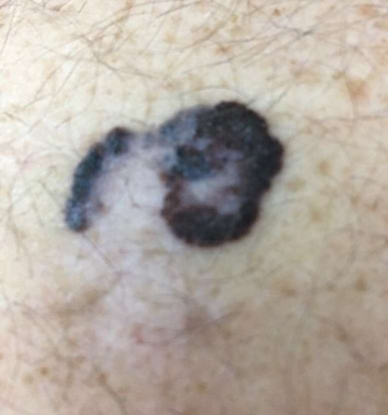 Melanoma é o tipo de câncer de pele menos comum e mais letal