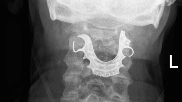 Médicos encontraram dentadura de homem em sua garganta oito dias após cirurgia no abdômen