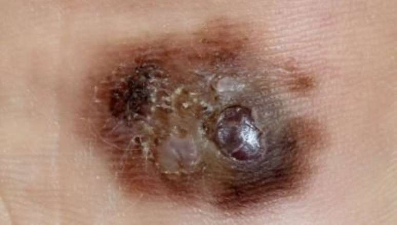 Melanoma - Foto: Shutterstock