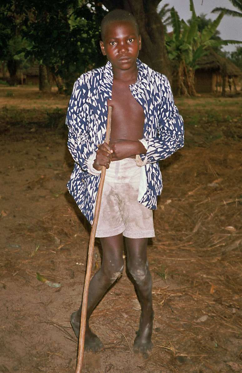 Menino com konzo, fotografado no Zaire (atual República Democrática do Congo) em setembro de 1986