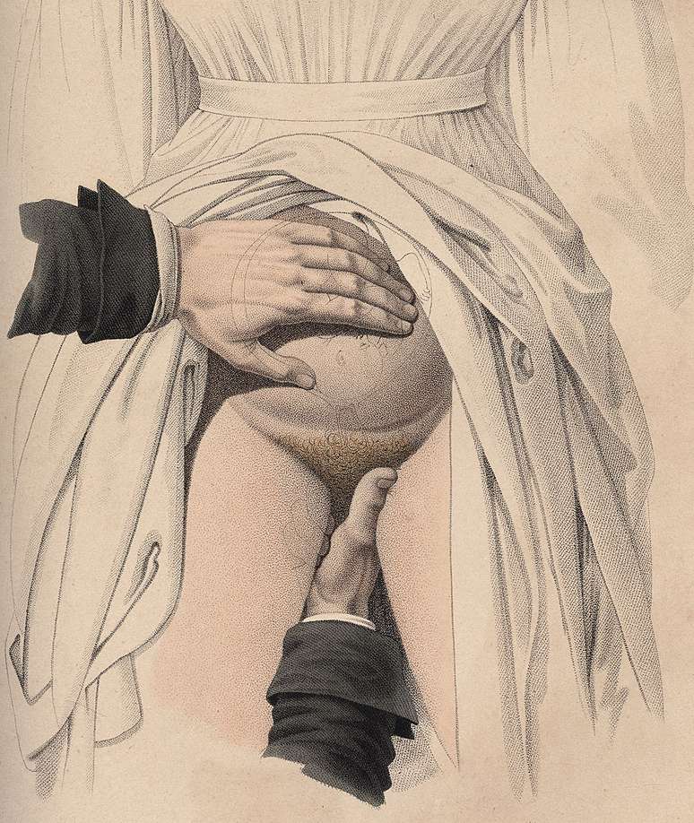 Os médicos, como podem ser vistos neste desenho de Jacques-Pierre Maygrier, de 1840, usavam as mãos ao fazer os partos, mas geralmente não eram tão limpas quanto nesta ilustração