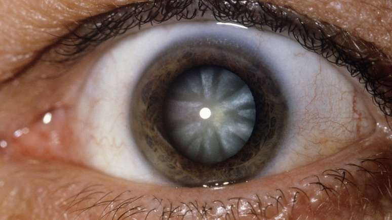 Uve&iacute;te pode desencadear outros problemas nos olhos, como catarata, glaucoma e edemas de retina