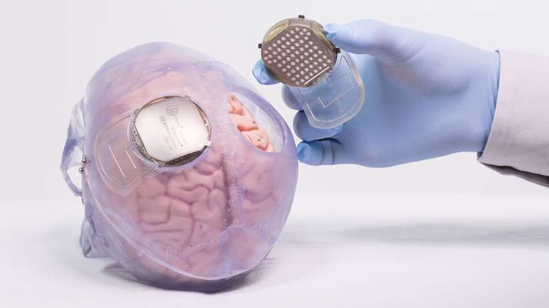 Sensores que s&atilde;o instalados no c&eacute;rebro