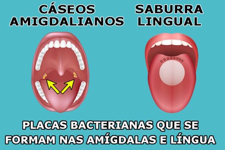 Cáseos amigdaliano (caseum): o que é, sintomas, causas e