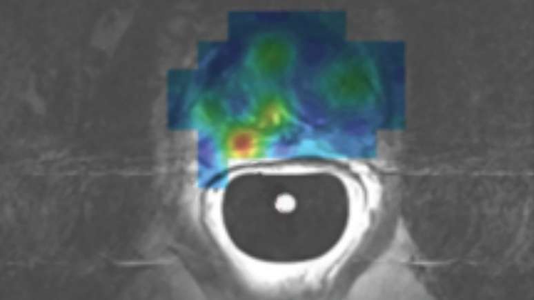 Imagem de uma ressonância magnética hiperpolarizada para detecção de câncer de próstata