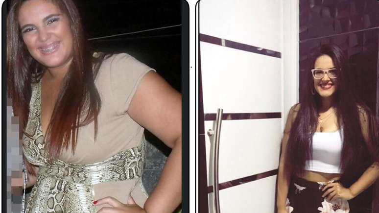 O estudante compartilha o 'antes e depois' da cirurgia nas redes sociais