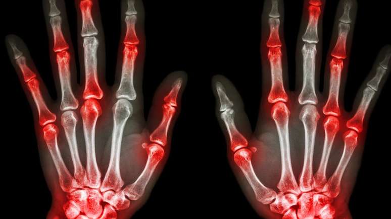 Os pesquisadores asseguram que a termografia identificaria melhor os sinais da artrite em comparação a outros métodos, como o ultrassom
